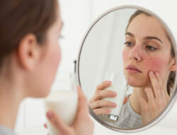 Hubungan Konsumsi Susu Sapi dengan Masalah Jerawat pada Dewasa